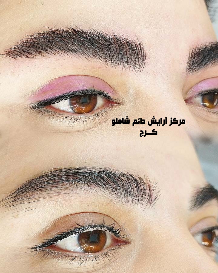 میکروبلیدینگ خوب در کرج میکروبلیدینگ خوب در کرج